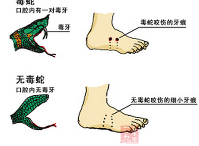 根据伤口分辨毒蛇虫